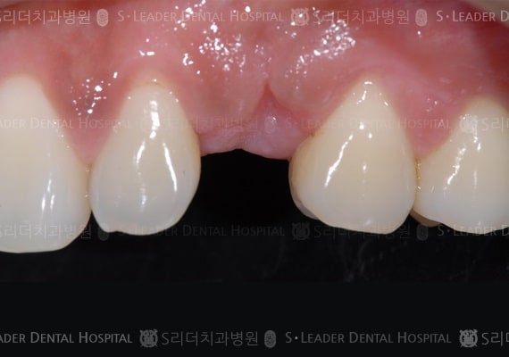 송곳니의 치료(심미보철), 만23세 남성 (증례 40)