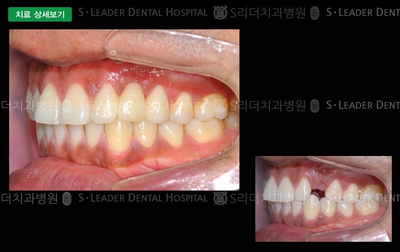 송곳니의 치료(심미보철), 만23세 남성 — 추가 사진 (대표 사례)
