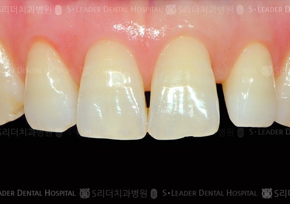 앞니 1개 치료(심미보철) 만49세 여성환자 (증례 43)
