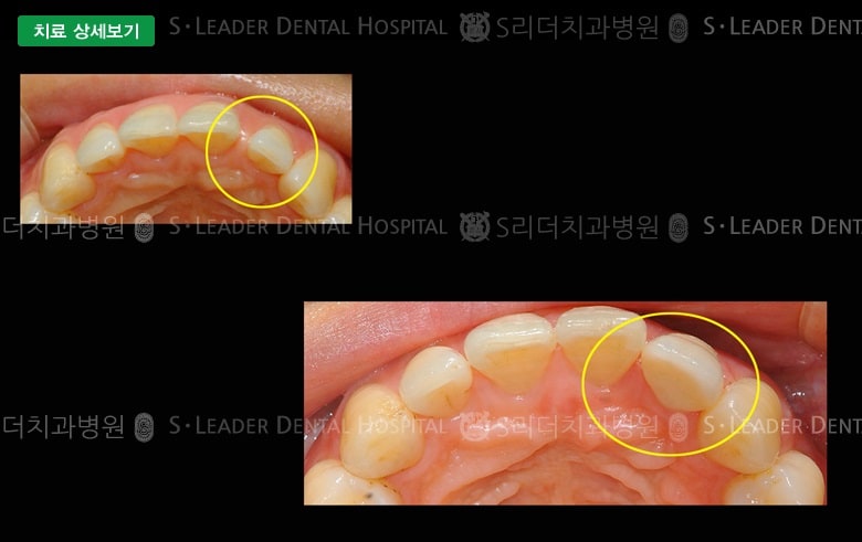 앞니 1개 치료(심미보철) 만49세 여성환자 — 추가 사진 (대표 사례)