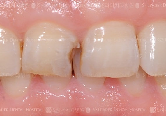 앞니 1개 치료 (심미보철), 만41세 남성환 (증례 34)