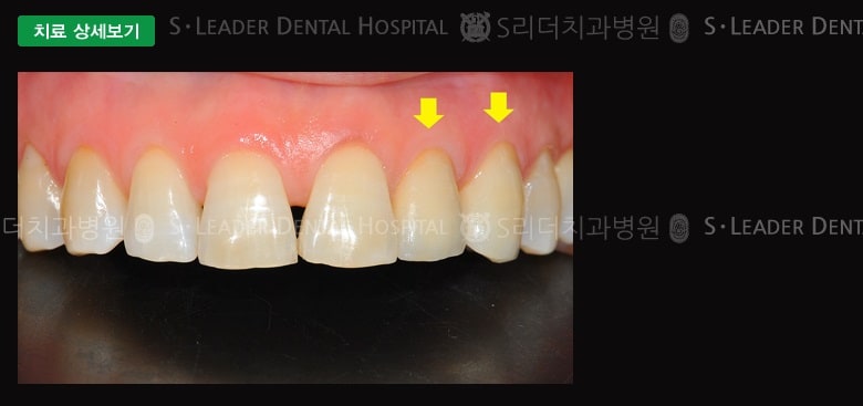 앞니 1개 & 송곳니 1개, 만55세 남성환자 — 추가 사진 (대표 사례)