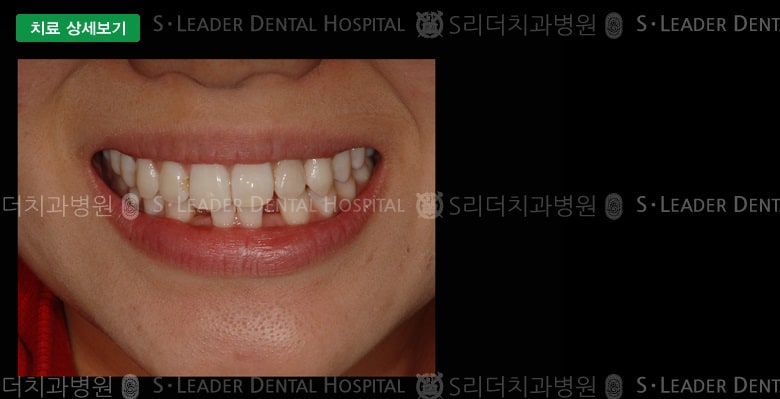 선천적 결손치아의 치료, 만28세 여성환자 — 추가 사진 (대표 사례)