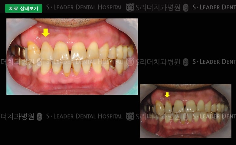 앞니 1개 치료(심미보철) 만53세 남성환자 — 추가 사진 (대표 사례)