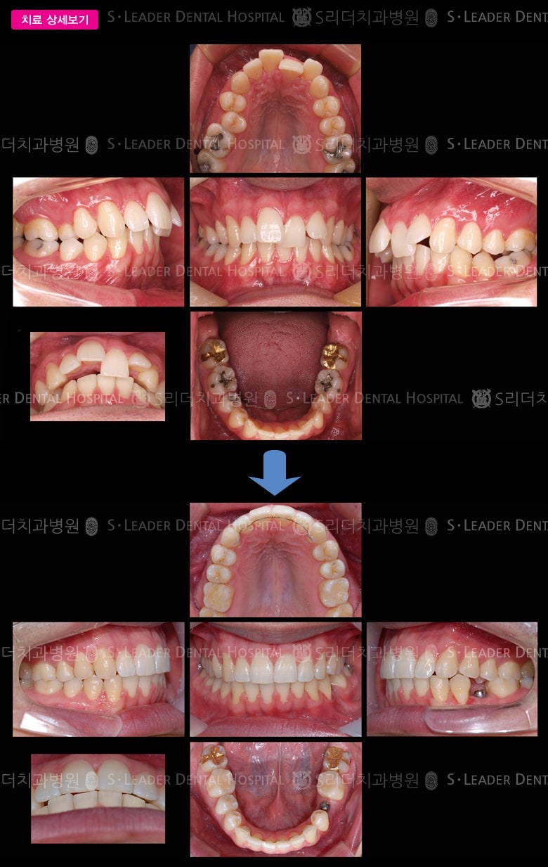 삐뚤삐뚤 (치아교정) 당시 만 28세 남성 — 추가 사진 (대표 사례)