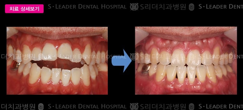 벌어진 입 (치아교정), 당시 만 27세 남성 — 추가 사진 (대표 사례)