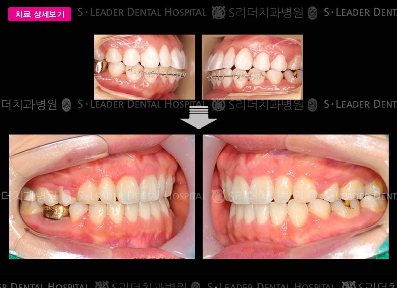 돌출입 (치아교정), 당시 만 25세 여성 — 추가 사진 (대표 사례)