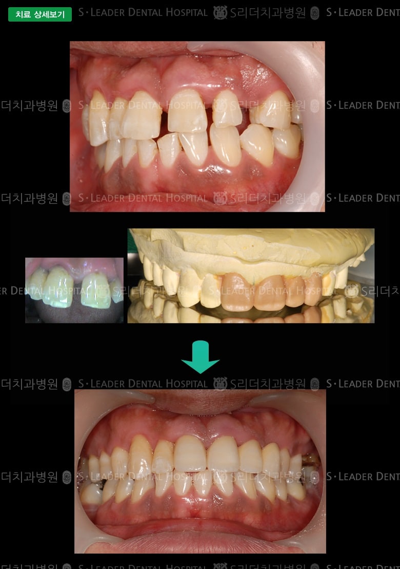 앞니4개 치료 (심미보철) 만39세 남성환자 — 추가 사진 (대표 사례)