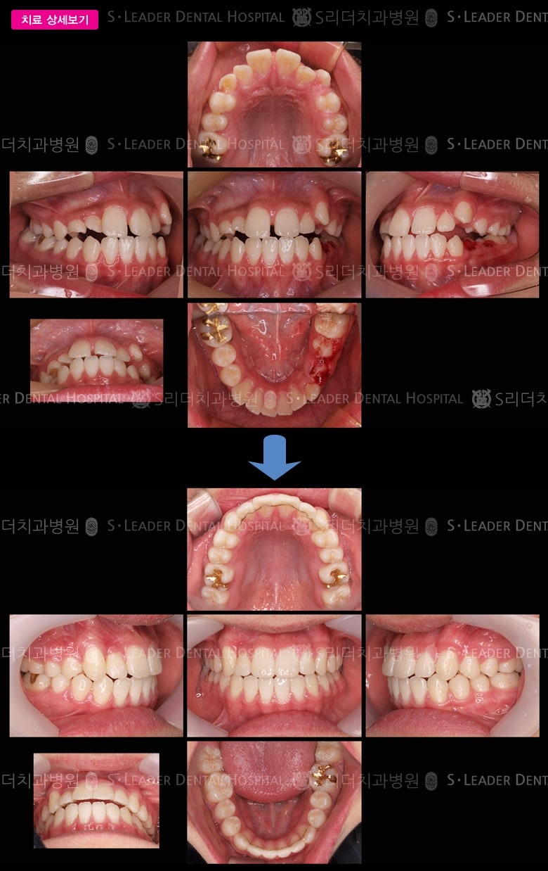 매복된 송곳니의 (교정치료) 당시 만15세 남 — 추가 사진 (대표 사례)