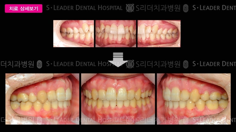 돌출입 (치아교정)  당시 만 30세 여성 — 추가 사진 (대표 사례)