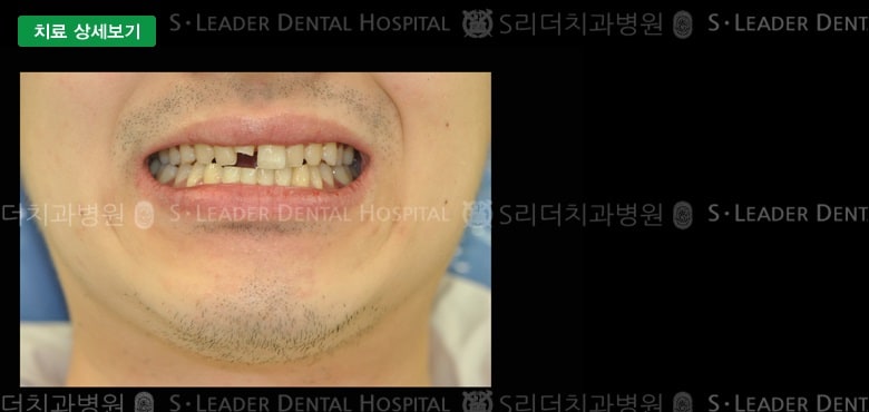 부러진 치아의 치료(심미보철) 만26세 남성 — 추가 사진 (대표 사례)