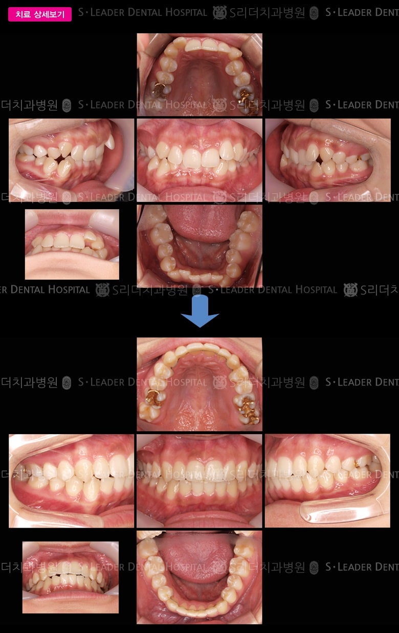 삐뚤삐뚤 (치아교정), 당시 만 24세 여성 — 추가 사진 (대표 사례)