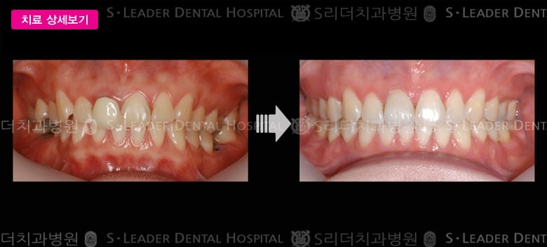 보철 대체한 (치아교정) 당시 만 26세 여성 — 추가 사진 (대표 사례)