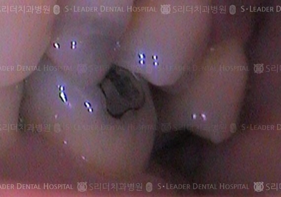 큰어금니 1개, 만46세 여성환자 (증례 63)