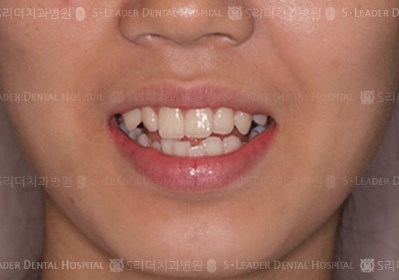 삐뚤삐뚤 (치아교정), 당시 만 18세 여성 (증례 74)