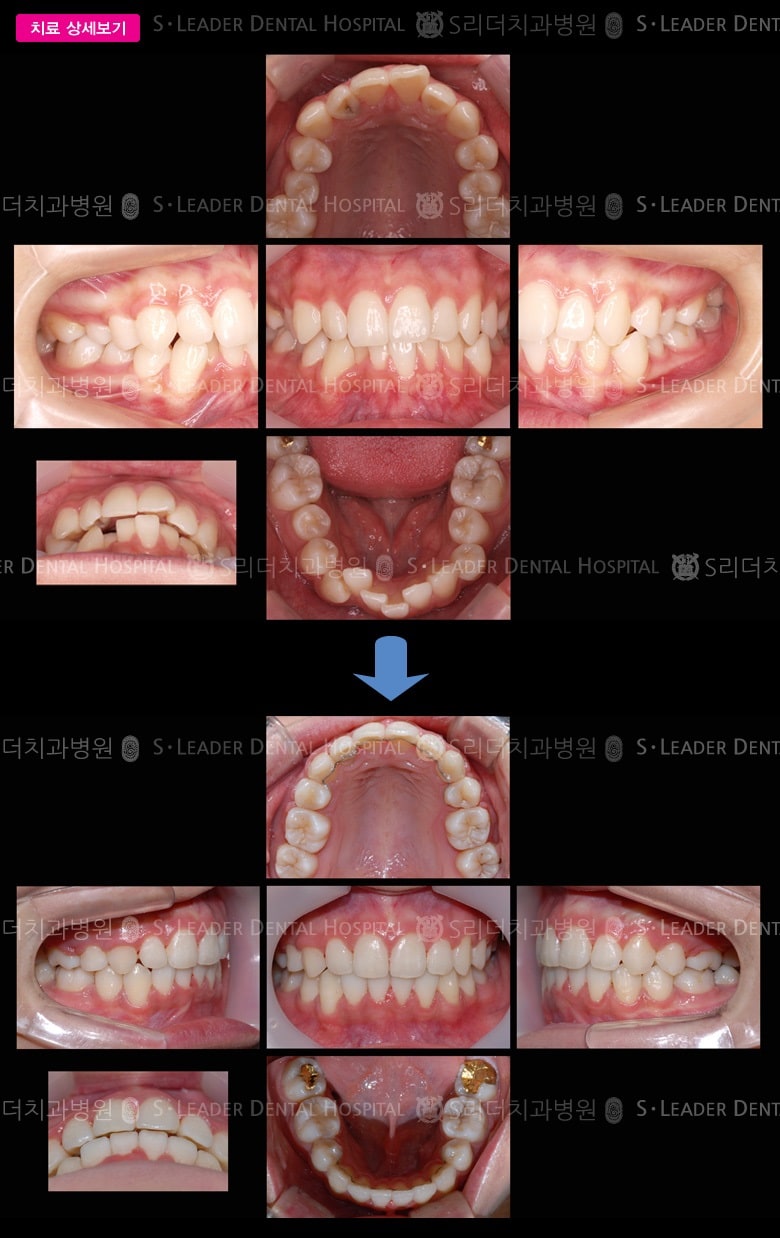 삐뚤삐뚤 (치아교정), 당시 만 18세 여성 — 추가 사진 (대표 사례)