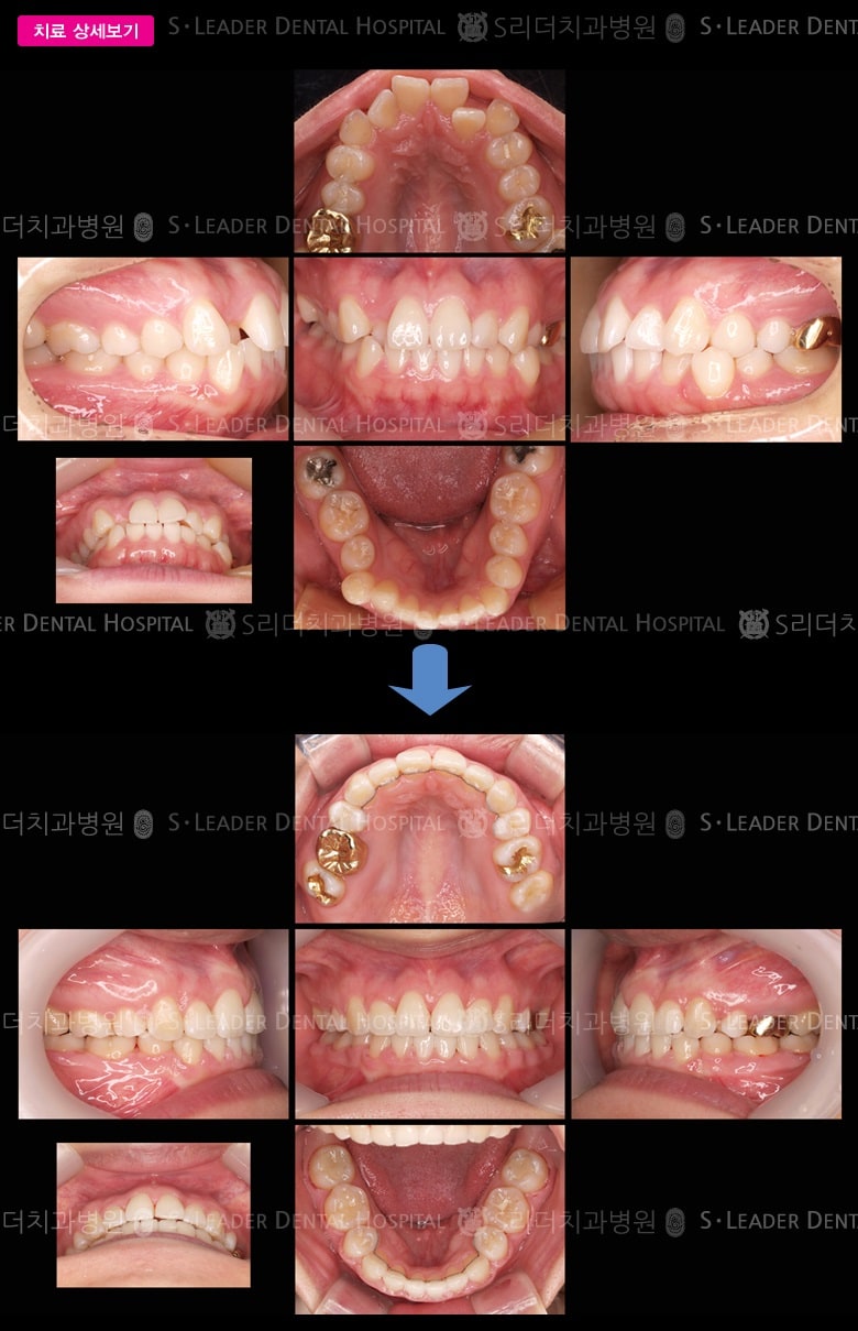 삐뚤삐뚤 (치아교정) — 추가 사진 (대표 사례)
