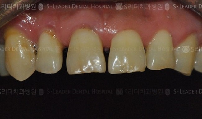 만 53세 남성환자, 앞니1개 치료 (증례 55)