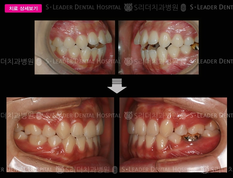 벌어진 입 (치아교정) 당시 만 19세 여성 — 추가 사진 (대표 사례)