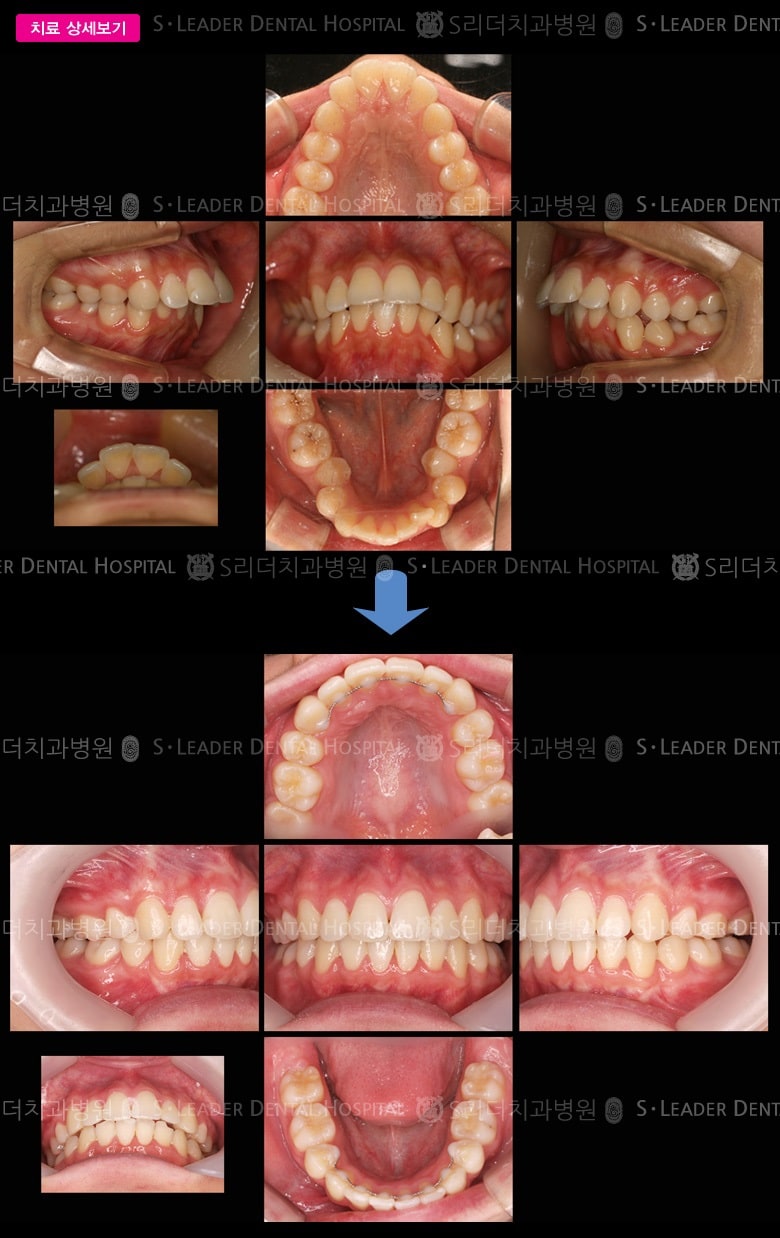 돌출입 (치아교정), 당시 만 20세 여성 — 추가 사진 (대표 사례)