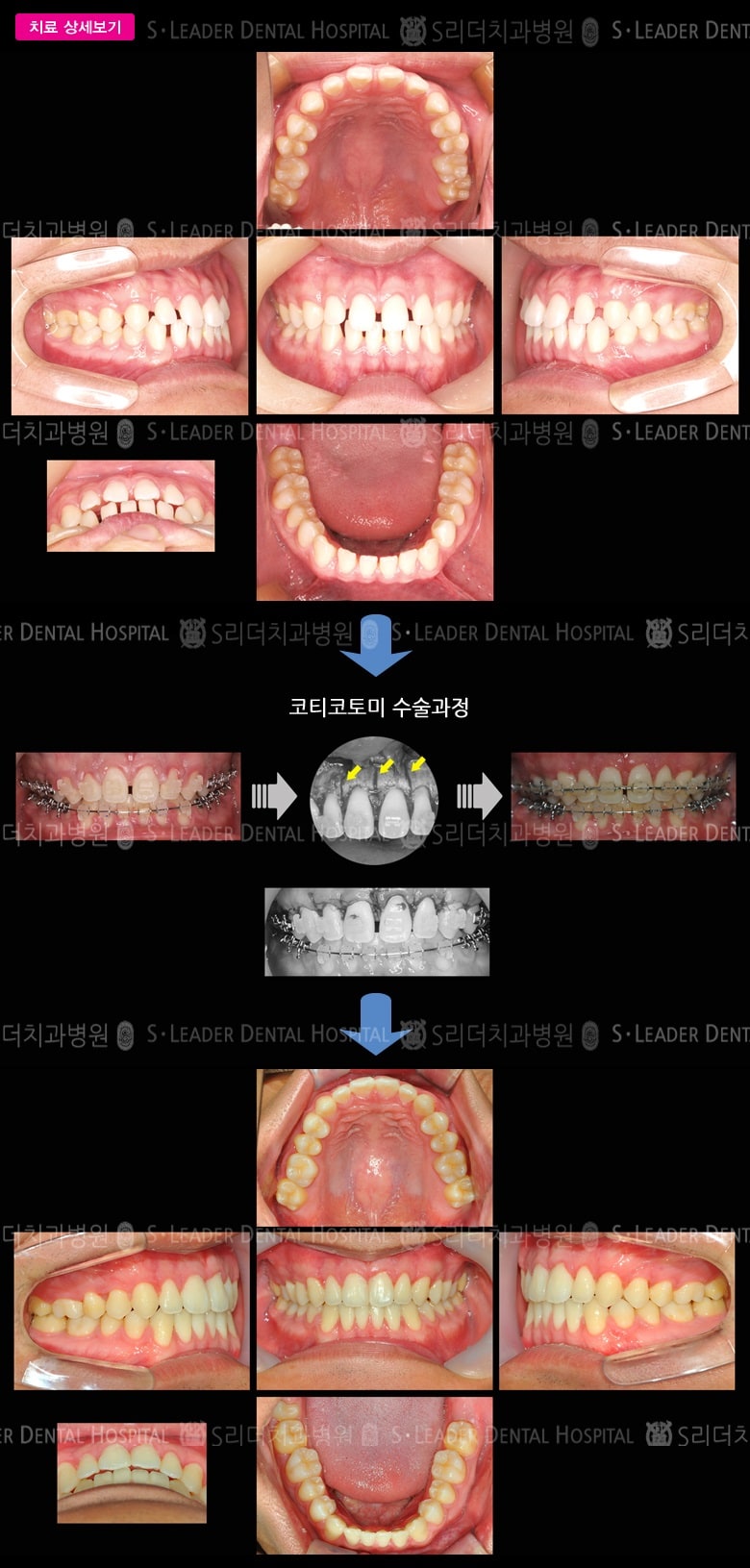 듬성듬성 (치아교정) , 당시 만 19세 남성 — 추가 사진 (대표 사례)