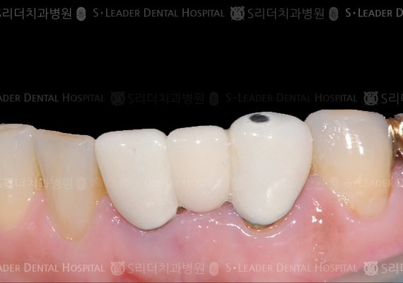 재치료 케이스(심미보철), 만66세 여성환자 (증례 56)