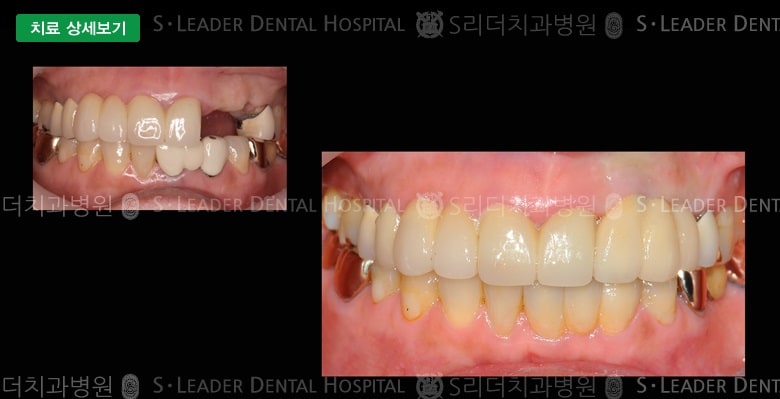 재치료 케이스(심미보철), 만66세 여성환자 — 추가 사진 (대표 사례)