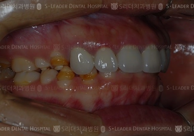 만 30세 여성환자,하악소구치4개 (증례 81)