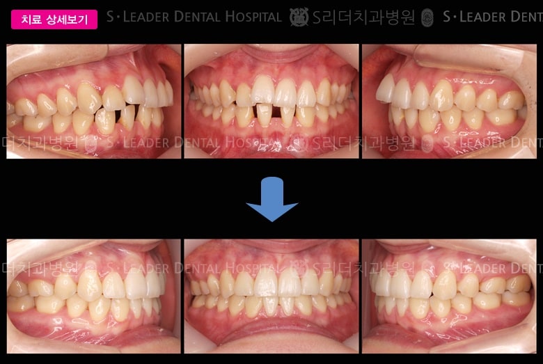 선천적 결손 (치아교정) 당시 만 29세 여성 — 추가 사진 (대표 사례)