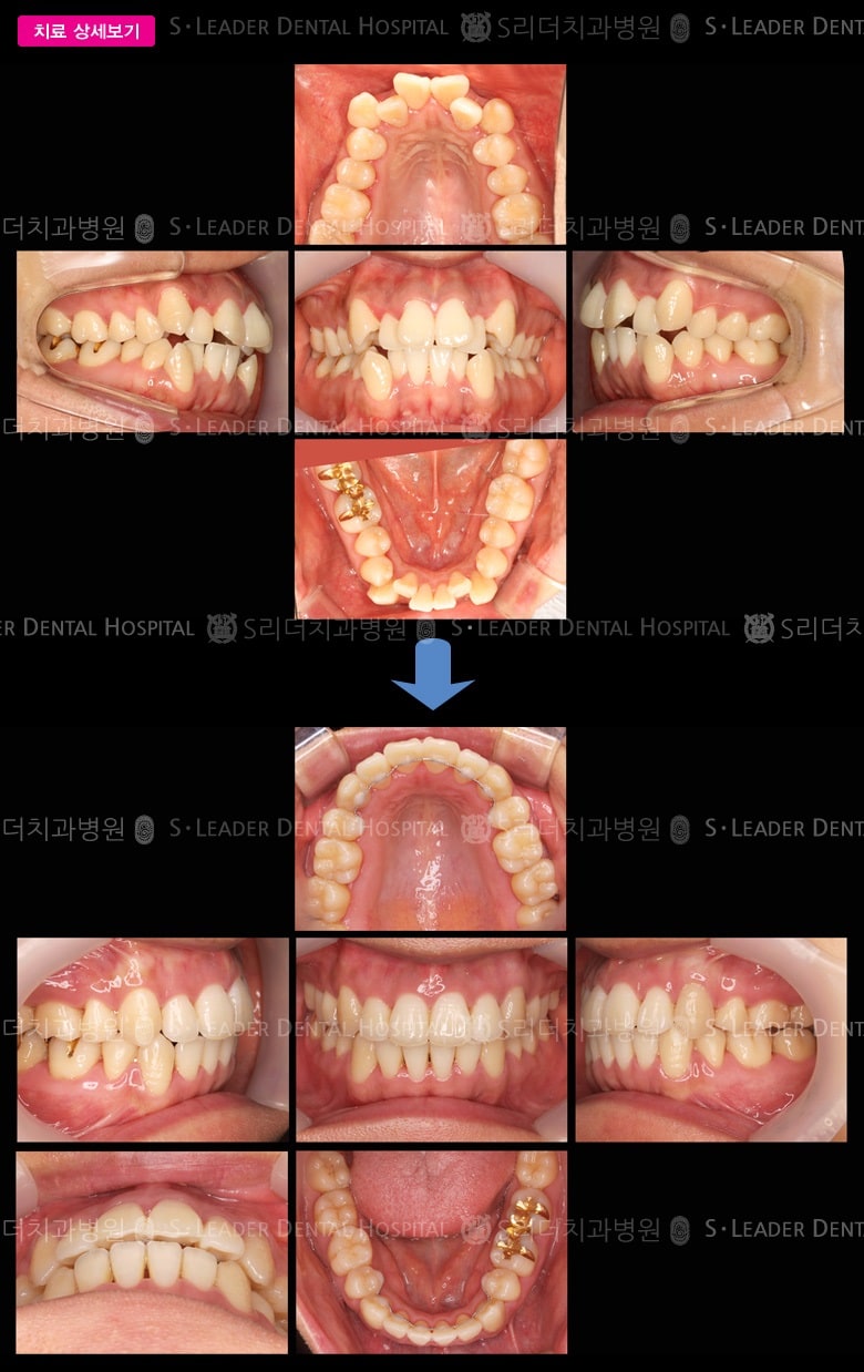 삐뚤삐뚤 (치아교정), 당시 만 33세 여성 — 추가 사진 (대표 사례)
