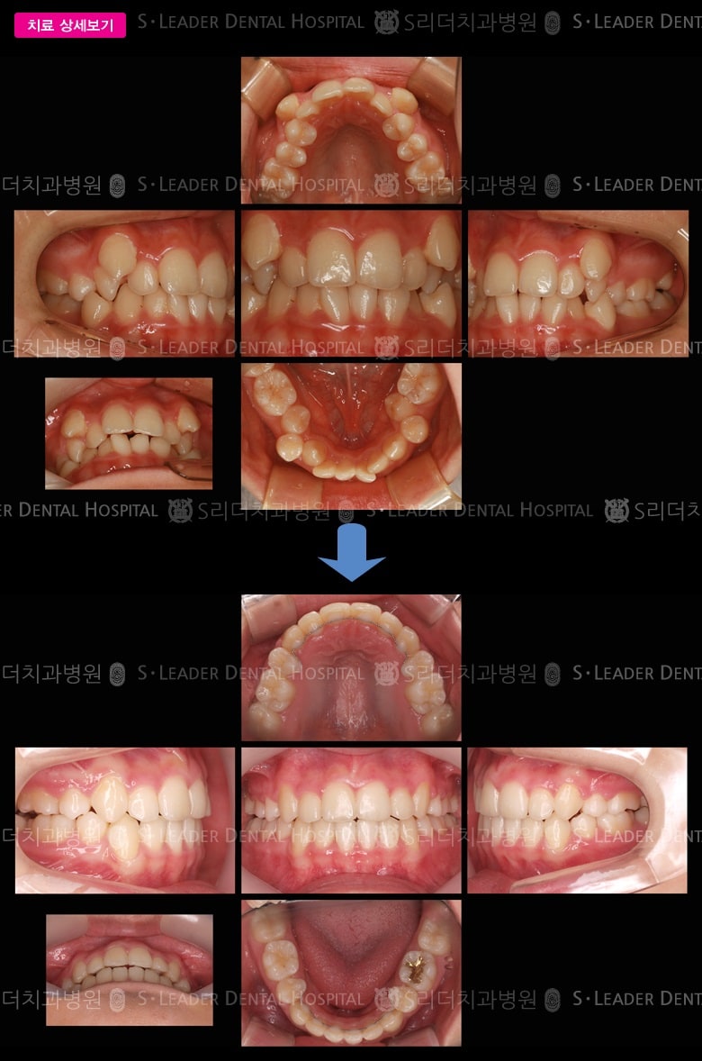 삐뚤삐뚤 (치아교정) 당시 만 18세 여성 — 추가 사진 (대표 사례)