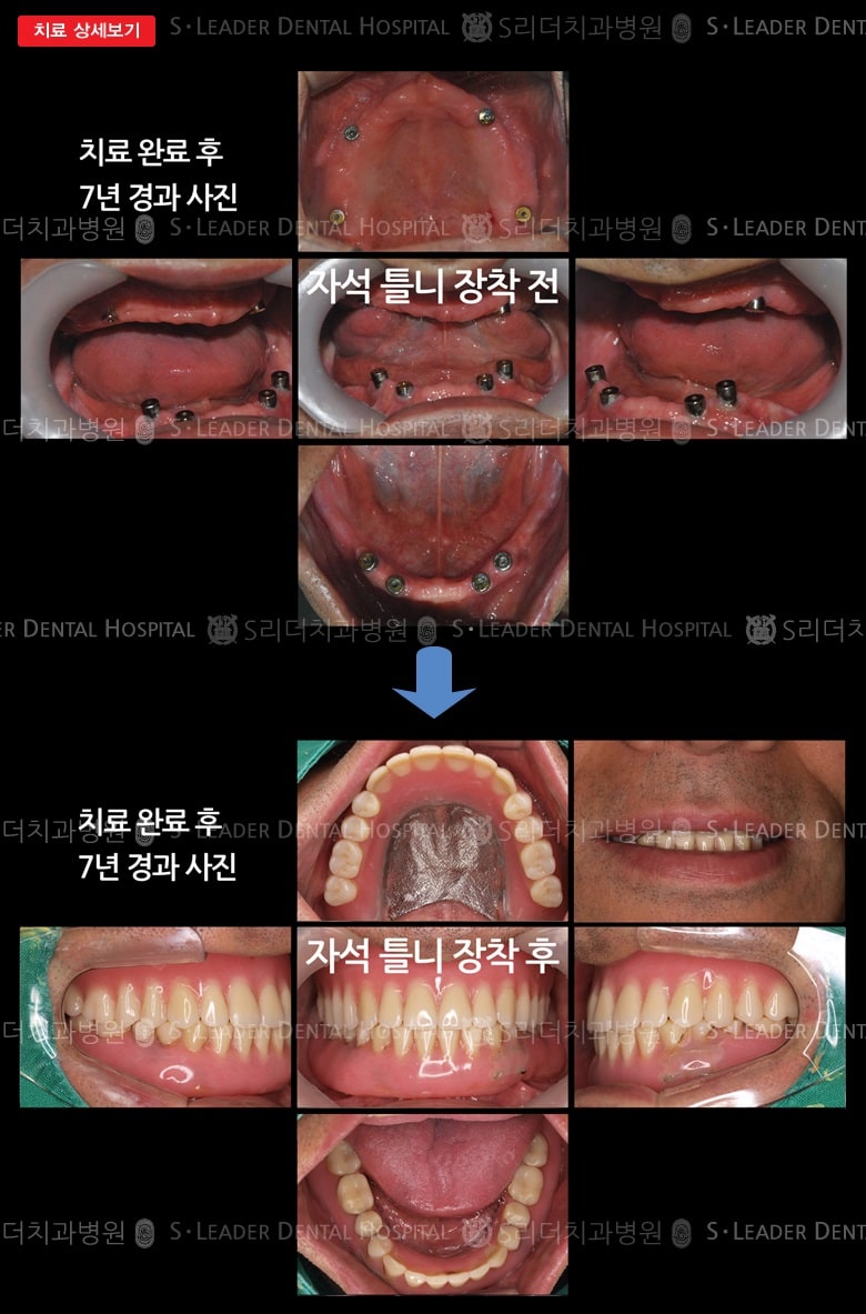 임플란트 유지 자석틀니 치료사례,만 53세 남 — 추가 사진 (대표 사례)