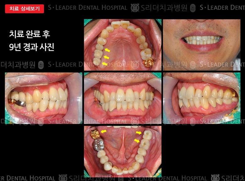 한쪽으로 위아래 어금니를 상실,만 53세 남성 — 추가 사진 (대표 사례)