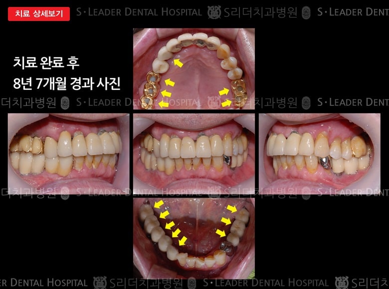 양쪽 위아래 어금니치료(임플) 만 72세 남성 — 추가 사진 (대표 사례)