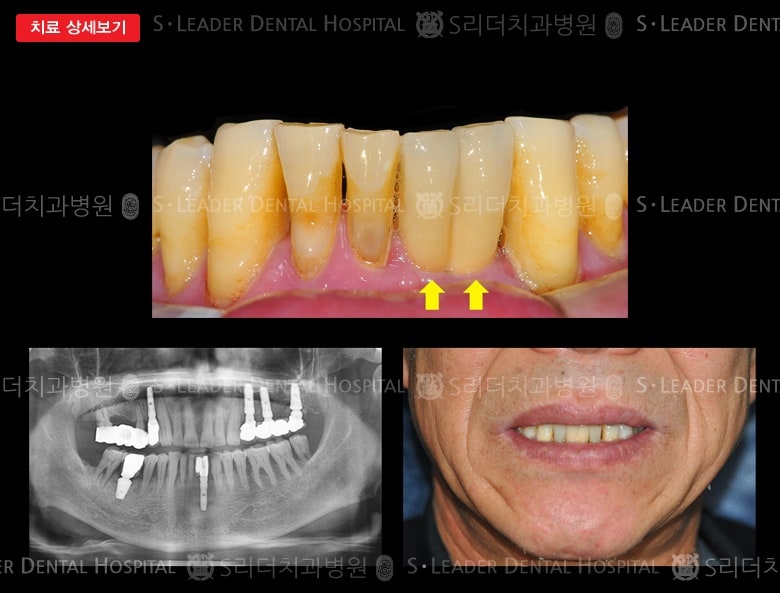 임플란트 1개로 앞니2개 제작,만 62세 남성 — 추가 사진 (대표 사례)