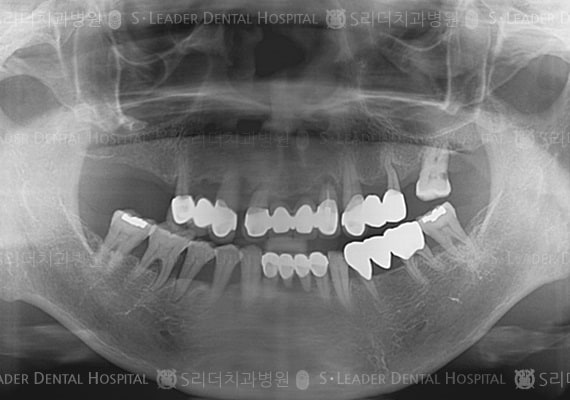 양쪽 위아래 어금니를 모두 상실,만 65세 여 (증례 150)
