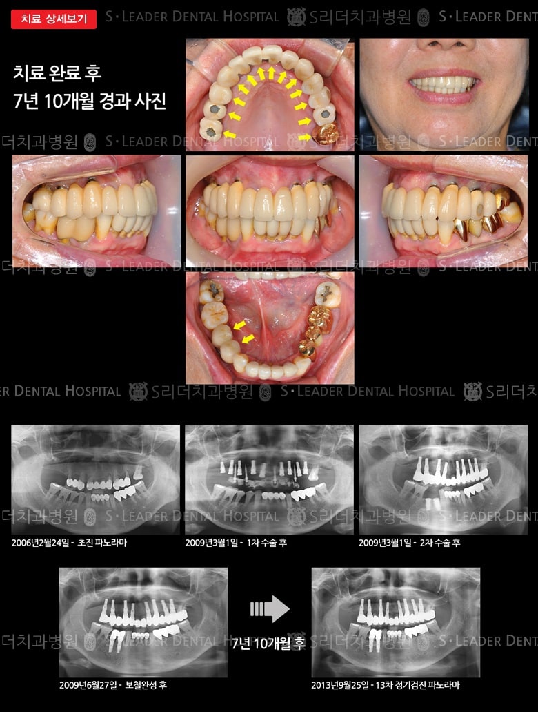 양쪽 위아래 어금니를 모두 상실,만 65세 여 — 추가 사진 (대표 사례)