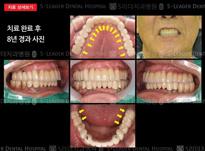 양쪽 위아래 어금니를 모두 상실,만71세남성 — 추가 사진 (대표 사례)