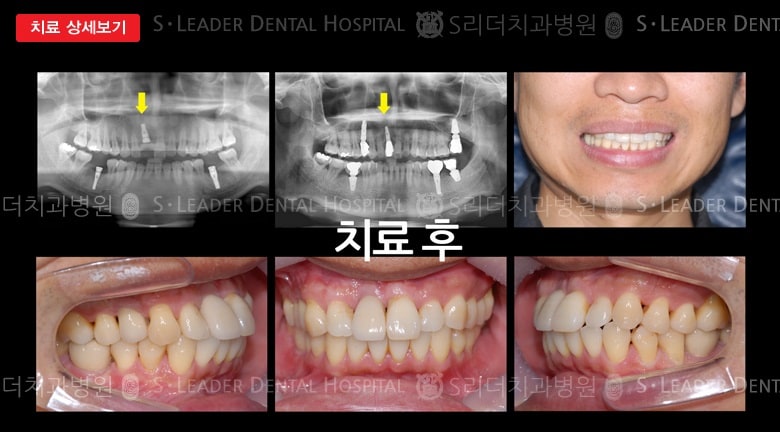앞니 1개(임플란트), 만40세 남성환자 — 추가 사진 (대표 사례)