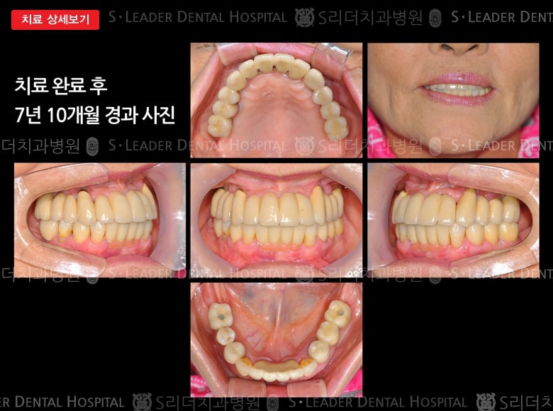 윗턱 전악 임플란트 치료사례, 만 68세 여성 — 추가 사진 (대표 사례)
