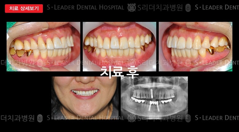윗턱,아래턱 앞니(임플)을 동시에 치료한 경우 — 추가 사진 (대표 사례)