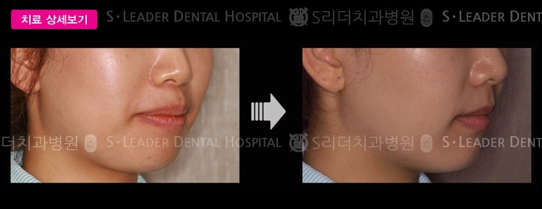 돌출입 (치아교정), 당시 만 29세 여성 — 추가 사진 (대표 사례)