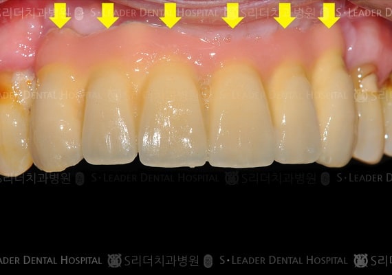 앞니6개 (임플란트), 만 44세 남성환자 (증례 143)