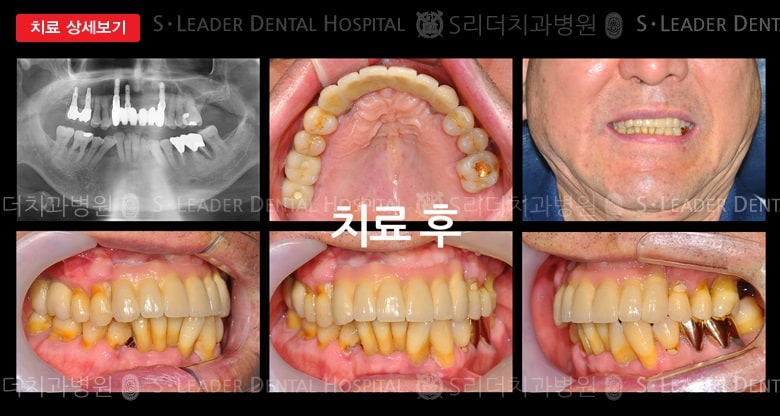 앞니6개 (임플란트), 만 44세 남성환자 — 추가 사진 (대표 사례)