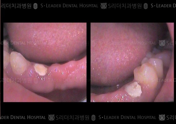 임플란트 2개로 앞니4개 제작,만 59세 여성 (증례 140)