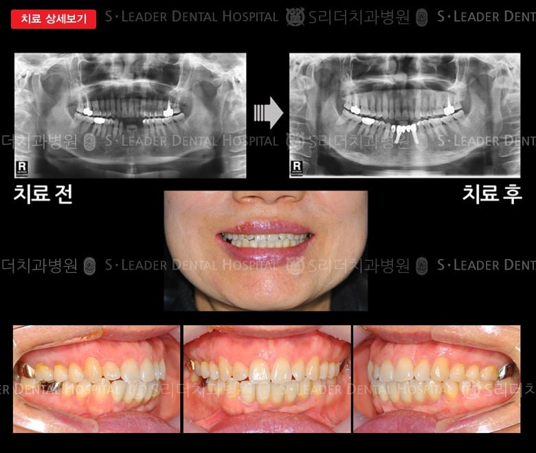 임플란트 2개로 앞니4개 제작,만 59세 여성 — 추가 사진 (대표 사례)
