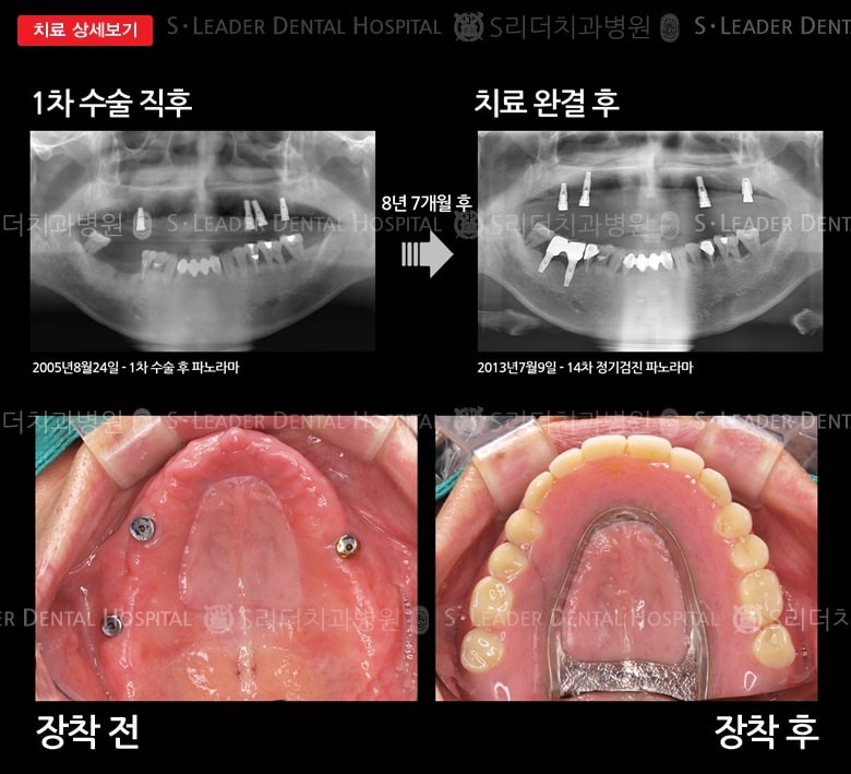임플란트 유지 자석틀니 치료사례,만 57세 남 — 추가 사진 (대표 사례)