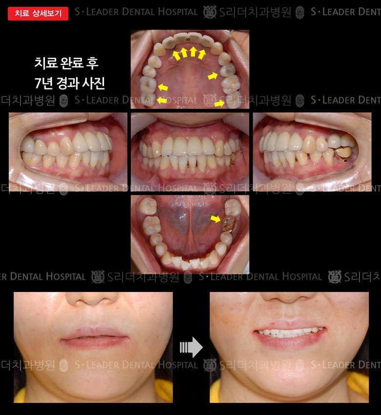 앞니4개 와 어금니5개 (임플),만 42세여성 — 추가 사진 (대표 사례)