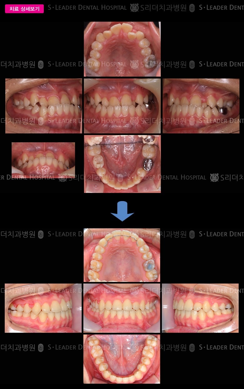 주걱턱 성장 (치아교정) 당시 만 14세 남성 — 추가 사진 (대표 사례)