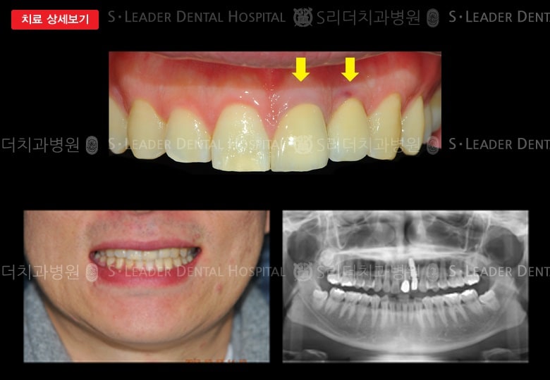 임플란트 1,올세라믹크라운 1, 만32세 남 — 추가 사진 (대표 사례)